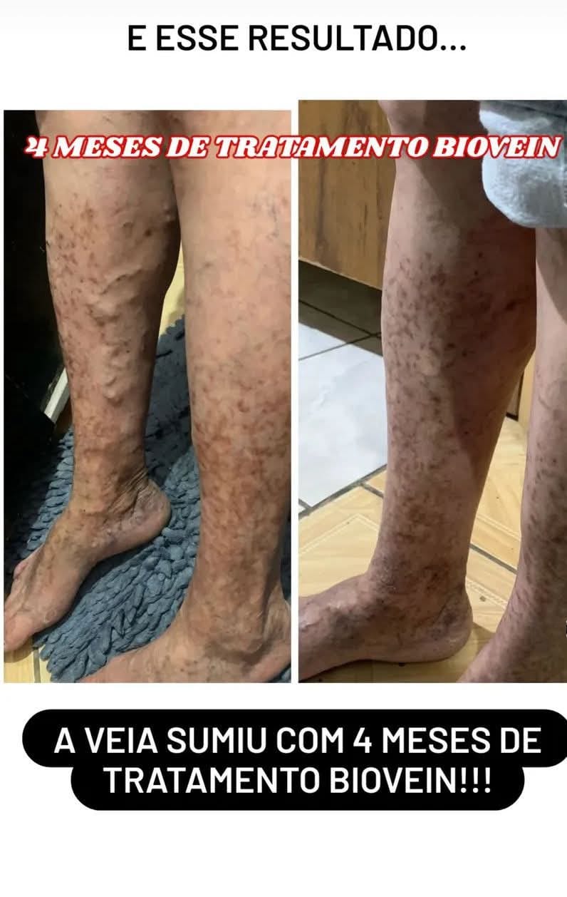 Depoimento de cliente sobre o Biovein — foto 2